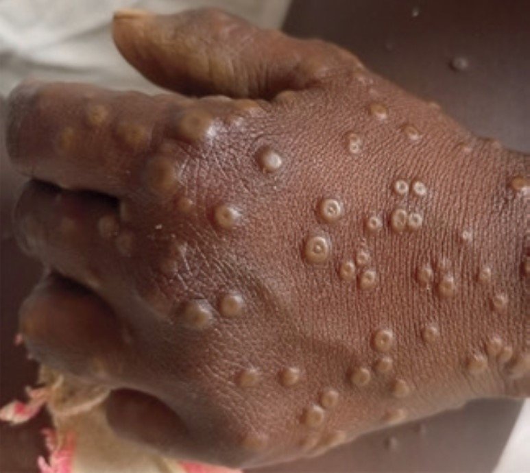 Premier cas du Virus MPOX en Guinée-Bissau